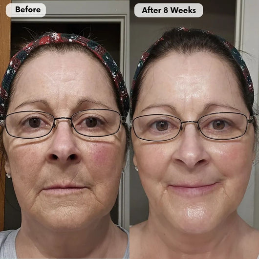 Rejuvera™ RenewMask